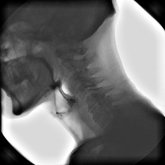 Still image from x-ray video of swallowing